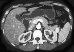 Splenic Artery Aneurysm - CTisus CT Scan