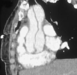 Aortic Dissection - CTisus CT Scan