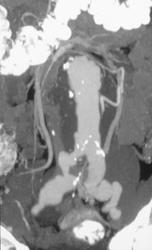 Dilated Iliac Artery Aneurysm - CTisus CT Scan