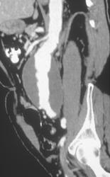 Aortic Aneurysm - CTisus CT Scan