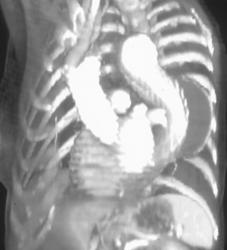 Stent in Aortic Aneurysm - CTisus CT Scan