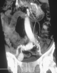 Aneurysmal Dilation of Iliac Artery - CTisus CT Scan