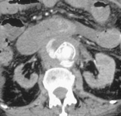 Leaking Aortic Aneurysms - CTisus CT Scan