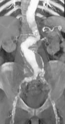 Aortic Aneurysms - CTisus CT Scan