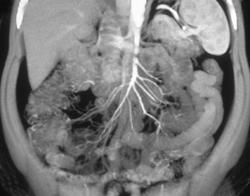 Mesenteric Anatomy - CTisus CT Scan