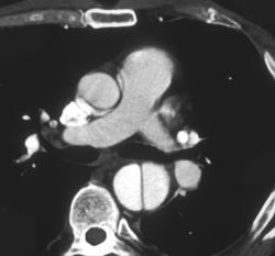 Aortic Dissection - CTisus CT Scan