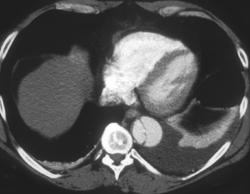 Aortic Dissection - CTisus CT Scan