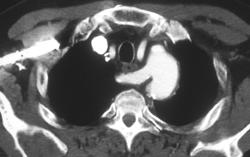 Aberrant Right Subclavian Artery - CTisus CT Scan