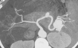 Splenic Artery Aneurysm - CTisus CT Scan