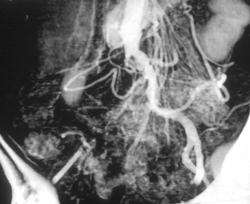 Occluded Right Iliac Artery - CTisus CT Scan