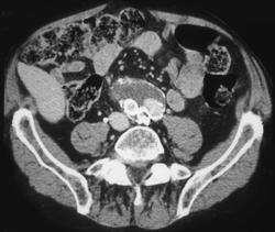 Leaking Endovascular Stent - CTisus CT Scan