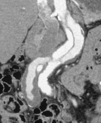 Aortic Dissection - CTisus CT Scan