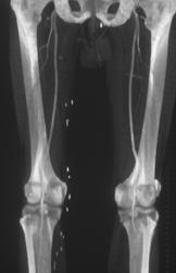 Run-off Study - CTisus CT Scan