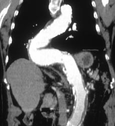 Aortic Aneurysm - CTisus CT Scan