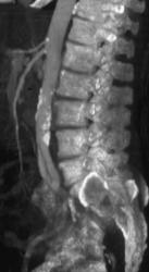 Stenosis of SMA and Celiac Artery - CTisus CT Scan