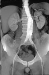 Endovascular Stent - CTisus CT Scan