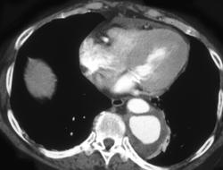 Aortic Ulceration With Dissection - CTisus CT Scan