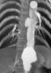 Focal Ulcer in Aorta - CTisus CT Scan