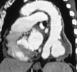 Aortic Aneurysm With Ulceration - CTisus CT Scan