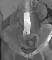 Endovascular Stent - CTisus CT Scan