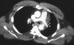 Aortic Dissection Post Trauma - CTisus CT Scan