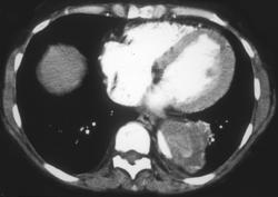 Aortic Dissection - CTisus CT Scan