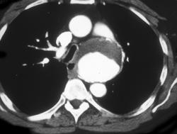 Aortic Dissection - CTisus CT Scan