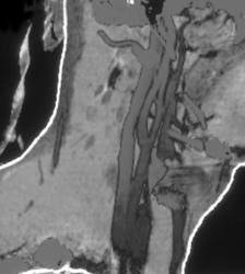 Normal Carotid Arteries - CTisus CT Scan