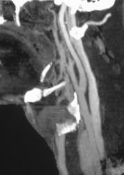 Normal Carotid Artery - CTisus CT Scan
