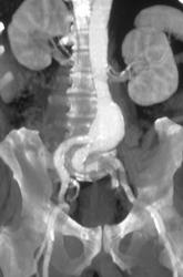 Focal Aortic Aneurysm - CTisus CT Scan