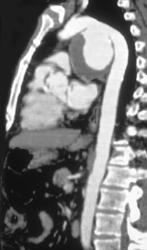 Ductus Aneurysm - CTisus CT Scan