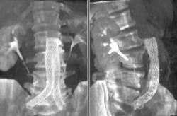 Endovascular Stent - CTisus CT Scan