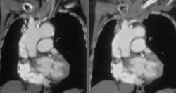 Aortic Root Dissection - CTisus CT Scan