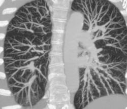 Normal Vasculature - CTisus CT Scan