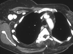 Dilated Axillary Vein in Klippel-Trenaunay-Weber (KTW) Syndrome - CTisus CT Scan