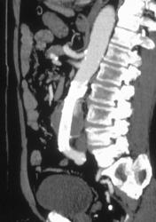 Aortic Aneurysm With Stent - CTisus CT Scan