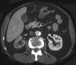 Dissection With Decreased Flow to Right Kidney - CTisus CT Scan