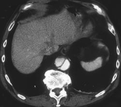 Aortic Dissection - CTisus CT Scan