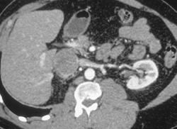 Leiomyosarcoma of the Inferior Vena Cava (IVC) - CTisus CT Scan