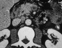 SMV Thrombosis - CTisus CT Scan