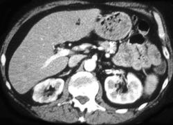 Decreased Flow to Right Kidney - CTisus CT Scan