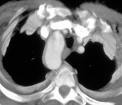 Vascular Ring - Vascular Case Studies - CTisus CT Scanning