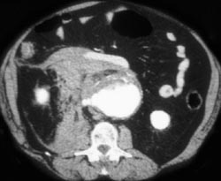 Active Leaking Aortic Aneurysm - CTisus CT Scan