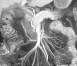 Normal Superior Mesenteric Artery (SMA) and Superior Mesenteric Vein (SMV) - CTisus CT Scan