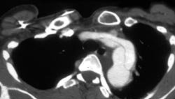 Type A Dissection - CTisus CT Scan