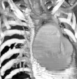 Marfan With Dissection - CTisus CT Scan