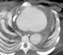 Aneurysm Ascending Aorta - CTisus CT Scan