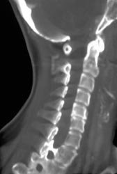 Vertebral Artery - CTisus CT Scan