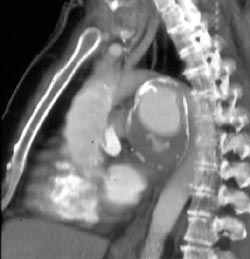 Ductus Aneurysm - CTisus CT Scan