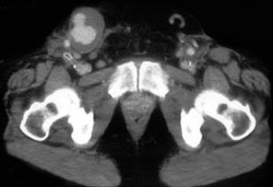 Pseudoaneurysm - CTisus CT Scan